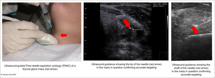 © Vincent Tan ENT Ultrasound-guided Fine-needle aspiration cytology (FNAC) of a thyroid gland mass (red arrow) Ultrasound-guidance showing the tip of the needle (red arrow) in the mass in question confirming accurate targeting Ultrasound-guidance showing the shaft of the needle (red arrow) in the mass in question confirming accurate targeting