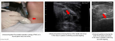 © Vincent Tan ENT Ultrasound-guided Fine-needle aspiration cytology (FNAC) of a thyroid gland mass (red arrow) Ultrasound-guidance showing the tip of the needle (red arrow) in the mass in question confirming accurate targeting Ultrasound-guidance showing the shaft of the needle (red arrow) in the mass in question confirming accurate targeting