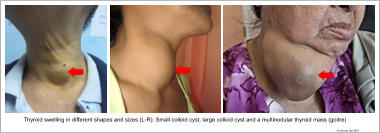 Thyroid swelling in different shapes and sizes (L-R): Small colloid cyst, large colloid cyst and a multinodular thyroid mass (goitre)  © Vincent Tan ENT