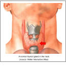 A normal thyroid gland in the neck (source: Netter Interactive Atlas)